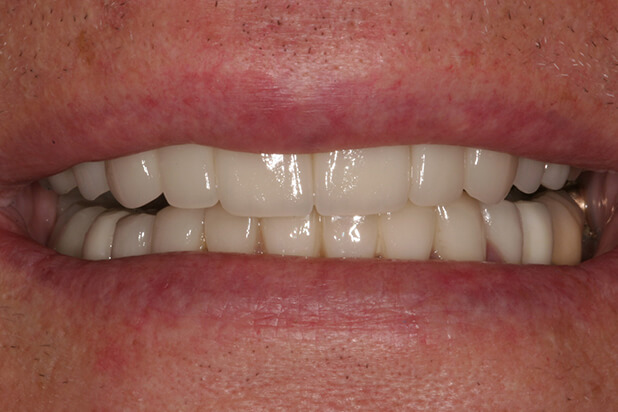 BJ's Smile After Cosmetic Treatment