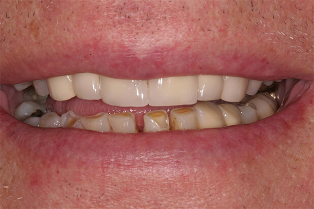 BJ's Smile Before Cosmetic Treatment