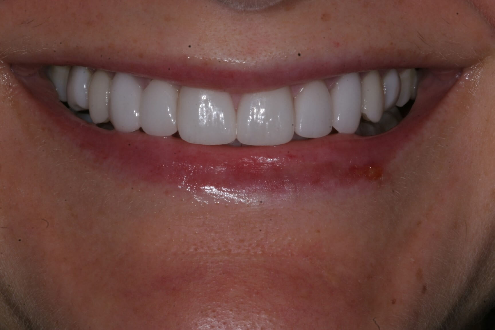 teeth whitening dentist in madison wisconsin