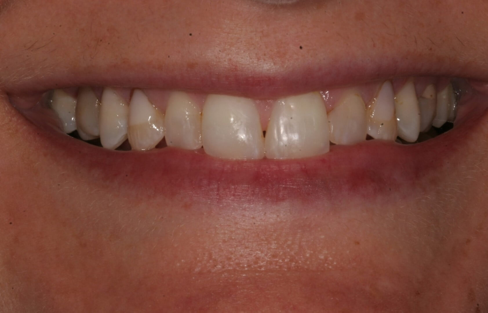 tooth restoration in madison