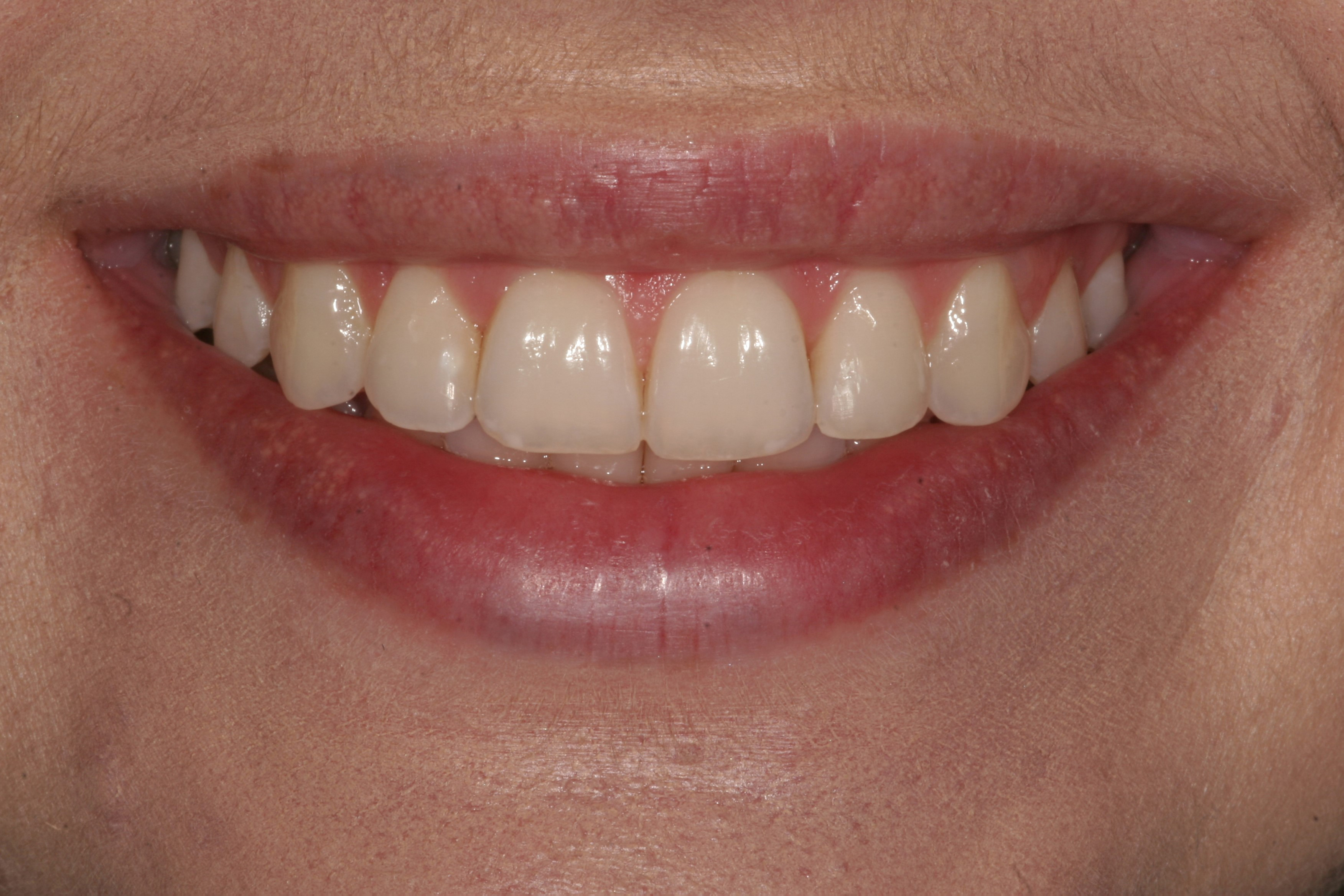 Gum and tooth reshaping in Madison, Wisconsin