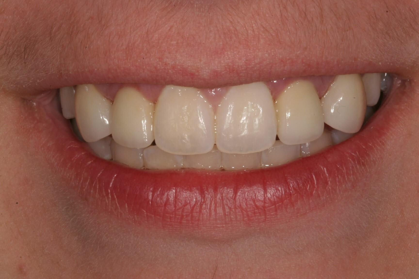 Aesthetic Gum and Bone Reshaping, two Dental Implants, and 4 Porcelain Restoration appointment in Madison