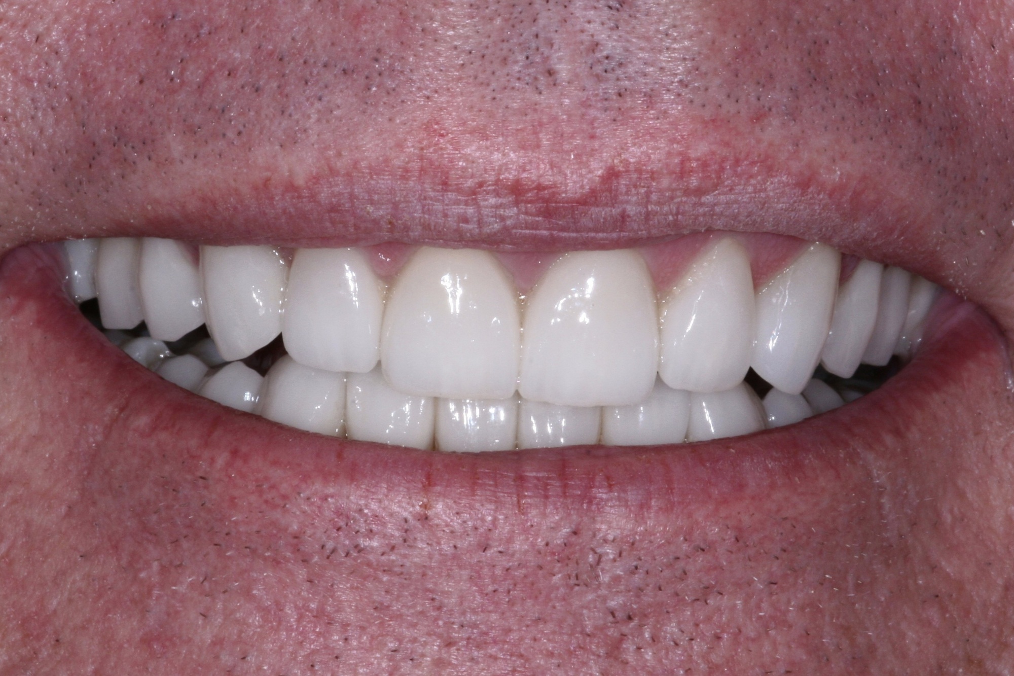 Steve's Smile After Cosmetic Dentistry Treatment