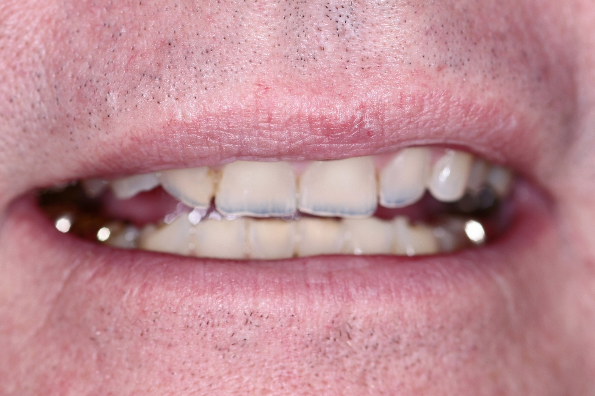Steve's Smile Before Cosmetic Treatment