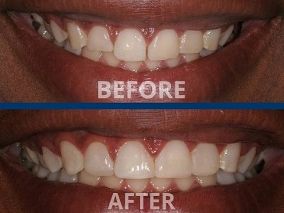 Smile Before and After Dental Contouring