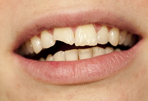 Chipped Tooth without Veneers