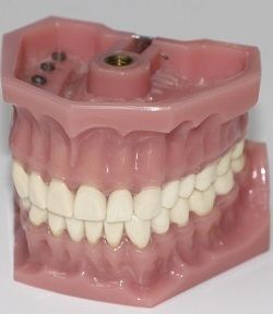 Model of Dentures