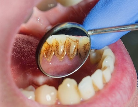 Oral Cancer Tooth Discoloration