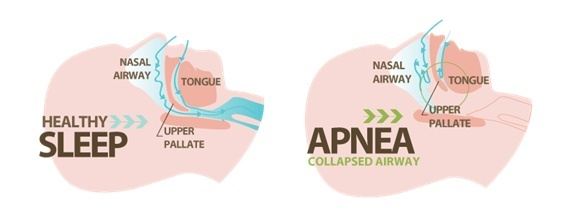 Sleep Apnea