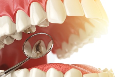 Model of Amalgam Filling