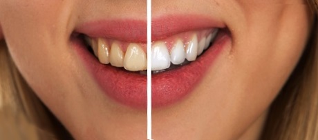Teeth Before and After Whitening