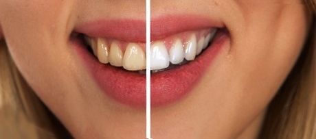 High-quality teeth whitening near Janesville, WI