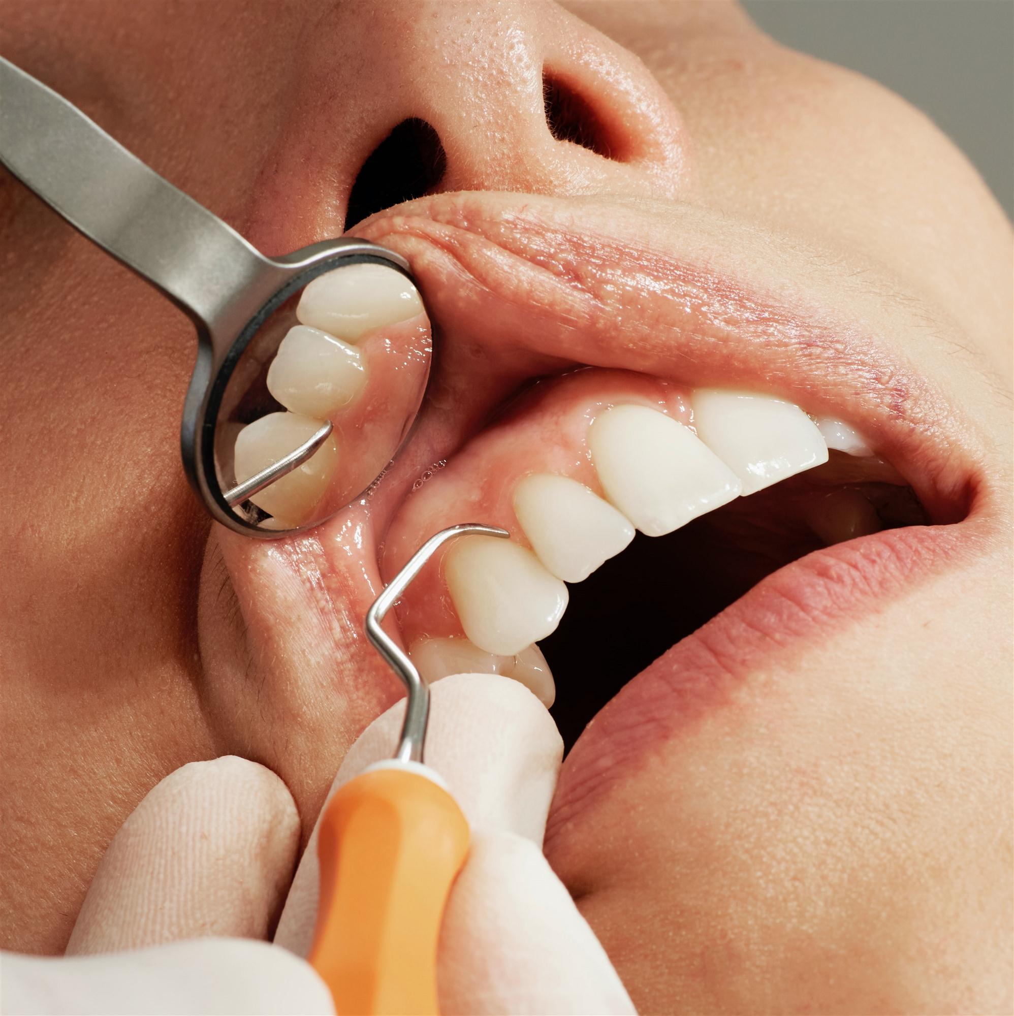 Preventative dental services