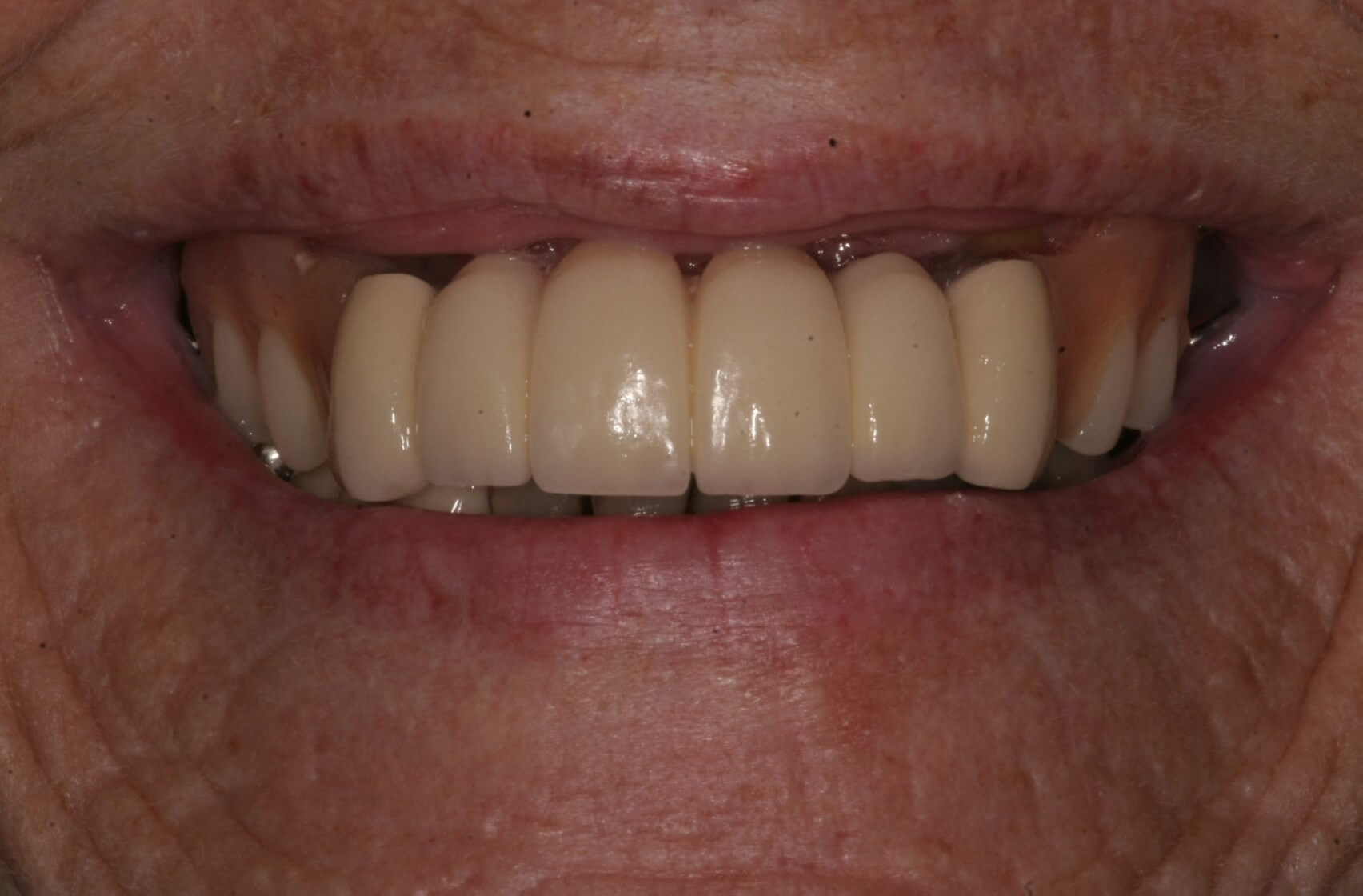 4 Life Changing Implants Dental work in Madison