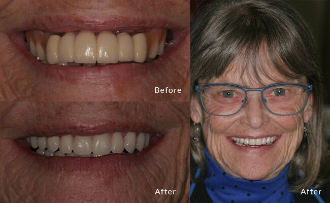 Madison veneer implant dentist