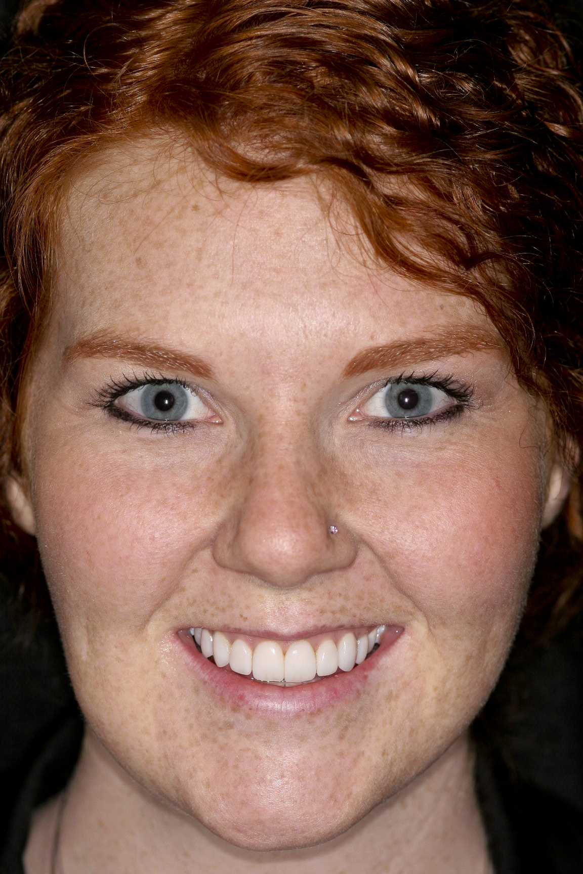 Check out Meghan's new smile! Meghan's New Smile
