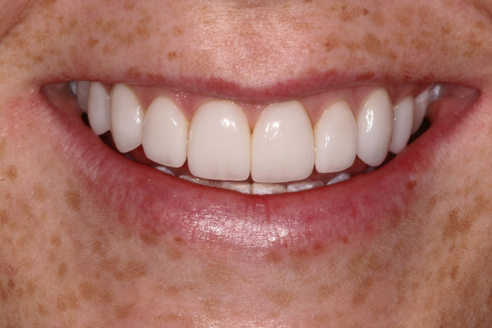 Meghan's Smile After Veneers, Whitening, and Invisalign