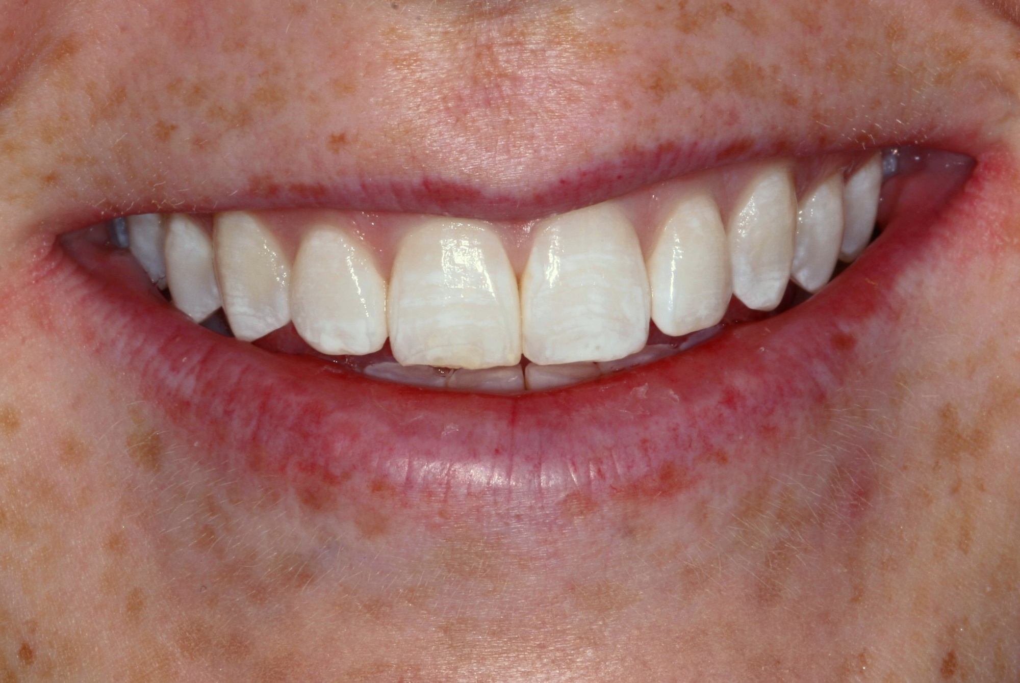 Meghan's Smile Before Veneers, Whitening, and Invisalign