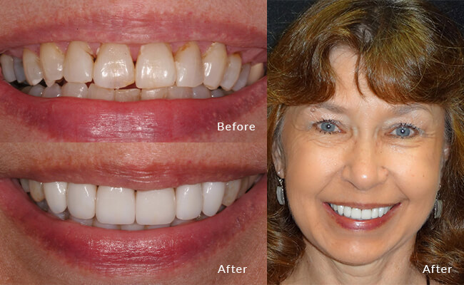 Barb Before - Join Barb on her smile transformation journey with this authentic "before" snapshot.