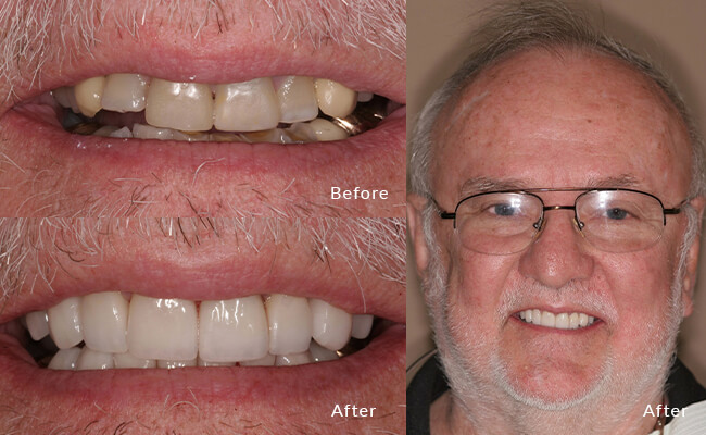 Bill Before - Witness Bill's smile evolution from this genuine "before" snapshot.
