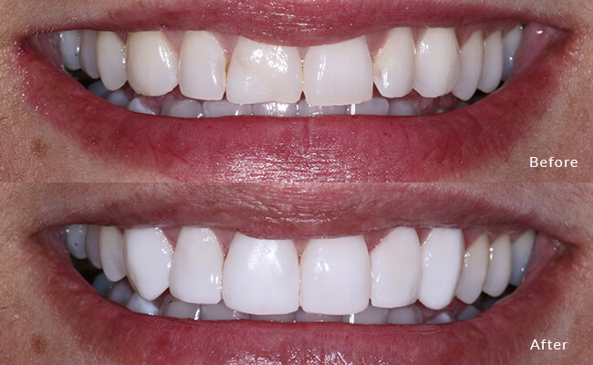 Bonded Veneer - Discover the wonders of bonded veneers, transforming smiles with a touch of magic.