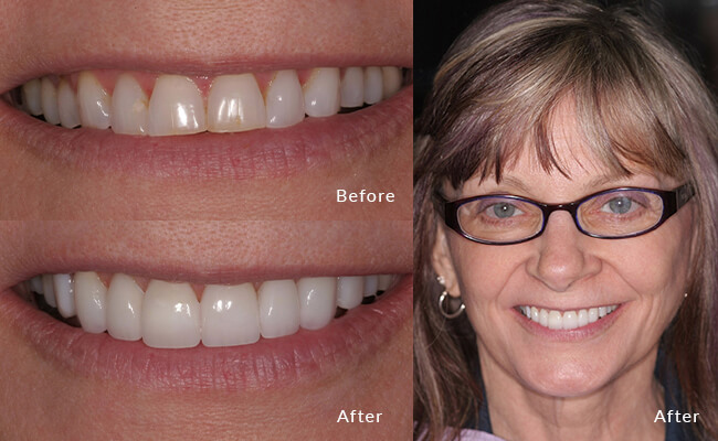 Christina Before - Embark on Christina's smile transformation journey with this heartfelt "before" snapshot.