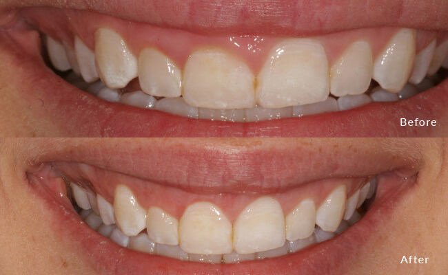 Crown Lengthening before and after photos