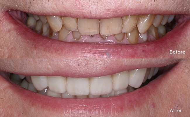 Crowns Before - Witness the beginning of a smile's royal journey with this charming "before" snapshot featuring dental crowns.