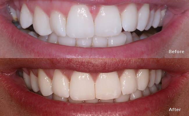 Invisalign Icon - Unlock the secret to a straighter smile with our friendly Invisalign icon.