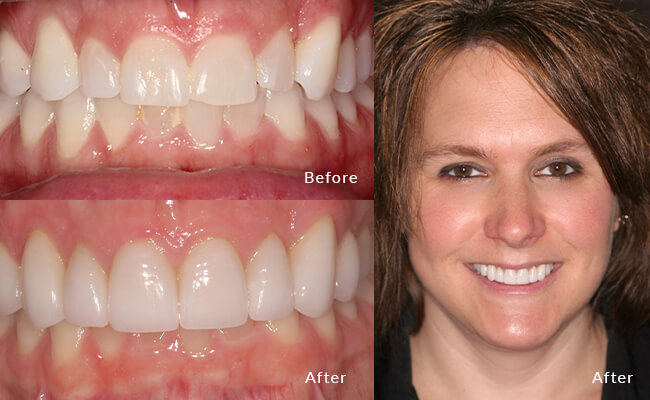 Witness Lisa's smile makeover: Before, demure; now, positively luminous!