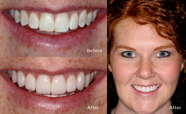 Meghan's smile story: Before, hesitant; now, beaming with confidence!