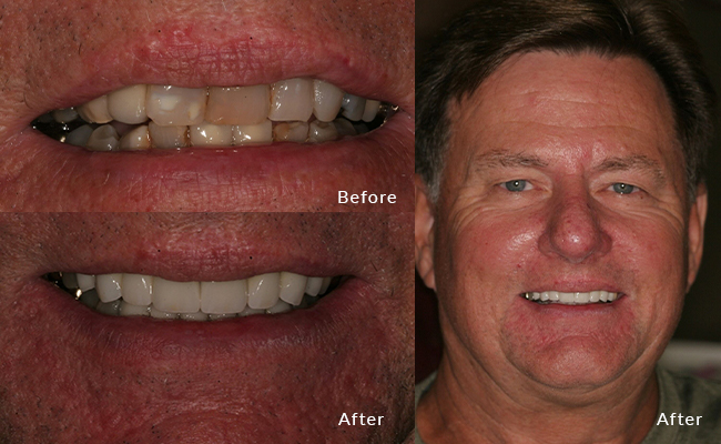 Michael's grin transformation: From subtle to strikingly charming!