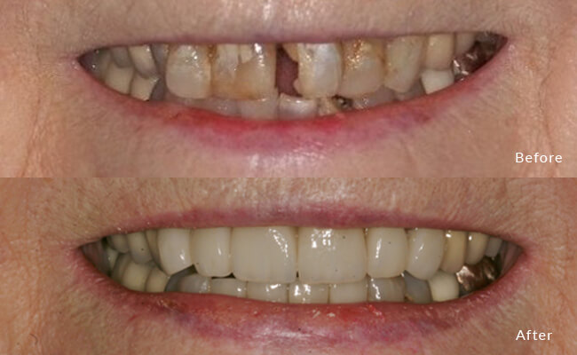 10 Porcelain veneer restoration