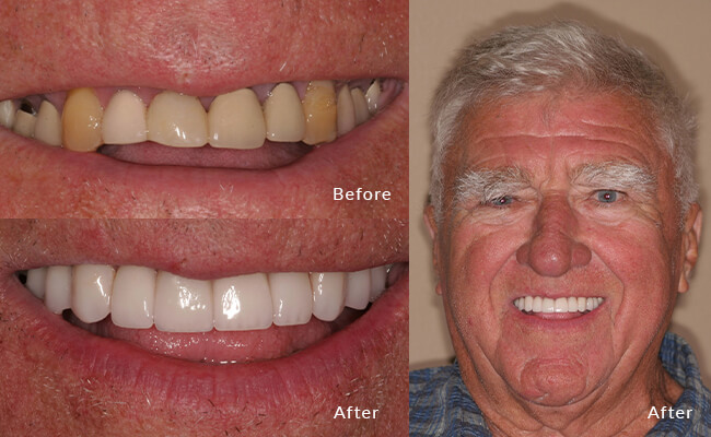 Verne's smile saga: Before, unassuming; now, utterly captivating!