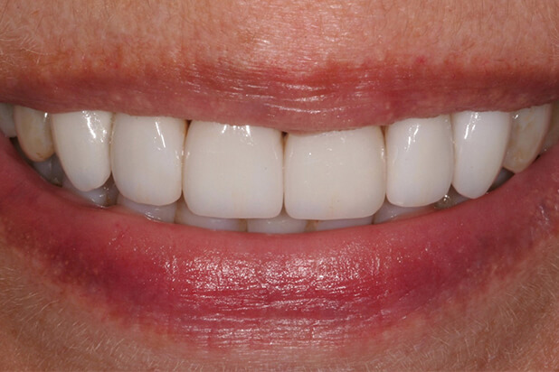 Barb's Smile After Veneers