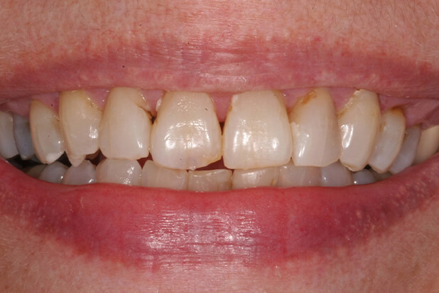 Barb's Smile Before Veneers