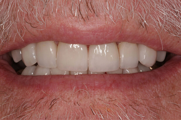 Bill's Smile After Cosmetic Treatment