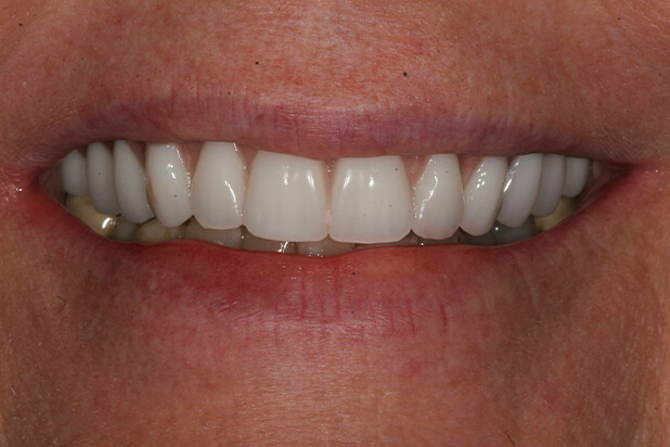See Jen's smile journey: Before, it was shy; now, it's radiant!