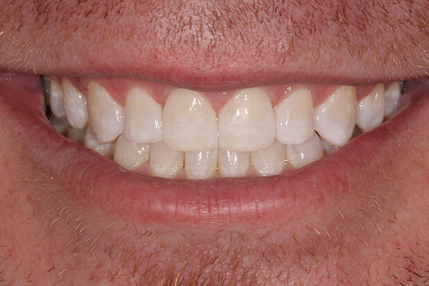 JT's Smile After Cosmetic Treatment
