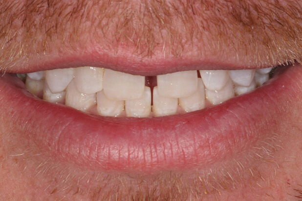 JT's Smile Before Cosmetic Treatment