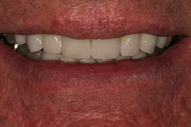 Michael After - Celebrate Michael's radiant smile transformation in this joyful "after" photo after dental care.