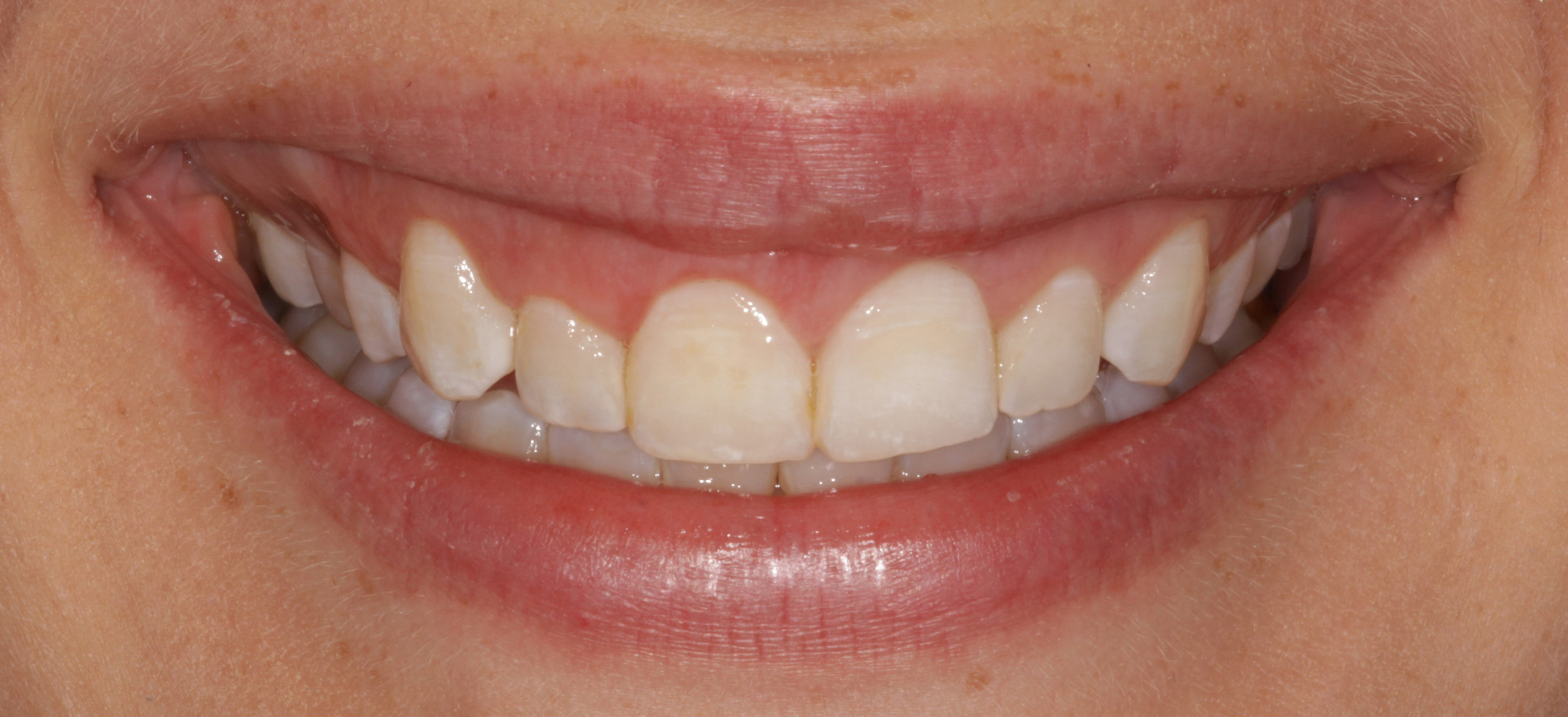 crown lengthening dentist Madison