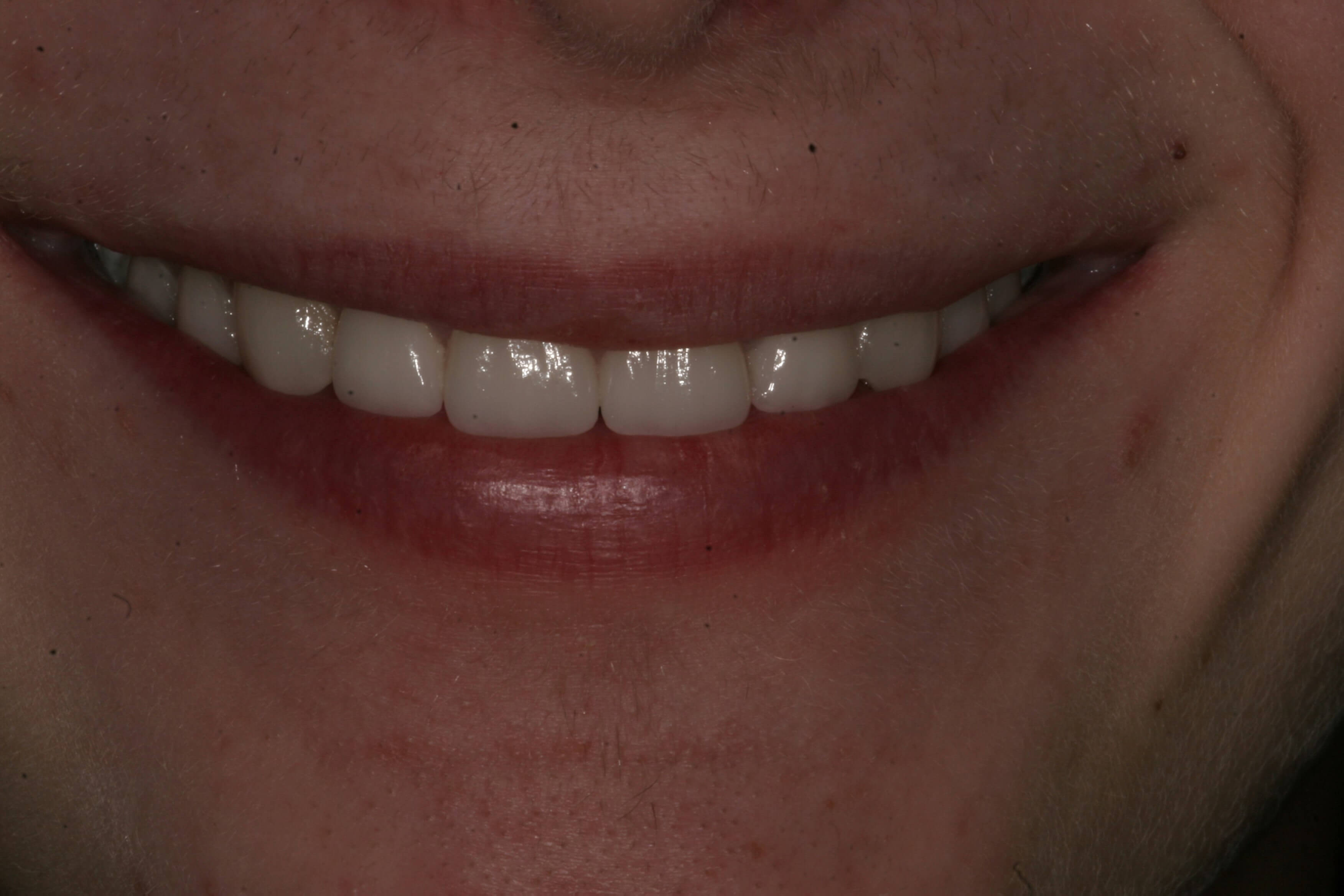 Madison cosmetic dentistry - porcelain veneers