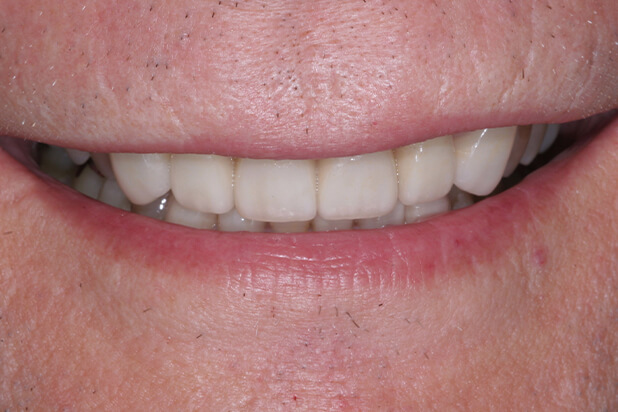 Crown Before - See the beginning of a smile's royal makeover with this charming "before" photo featuring a dental crown.