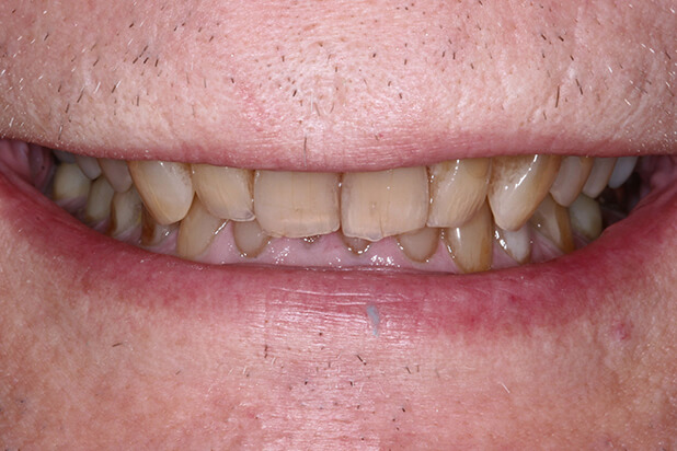Crown After - Behold the regal transformation of a smile in this majestic "after" photo with a dental crown.
