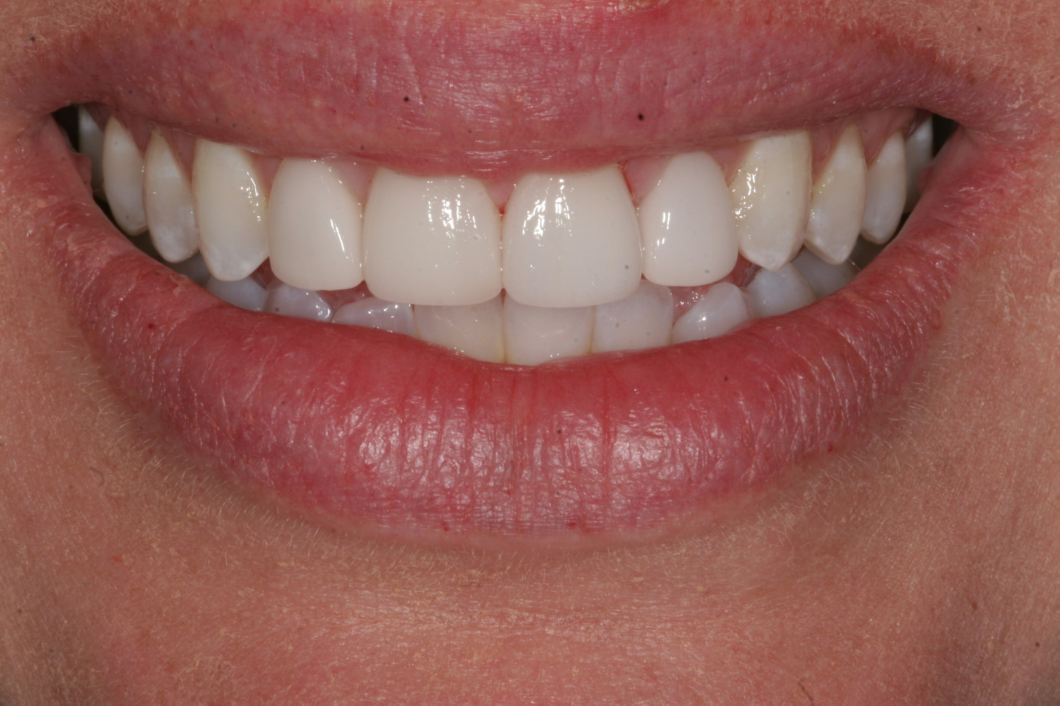 Invisalign & veneer dentistry in Wisconsin