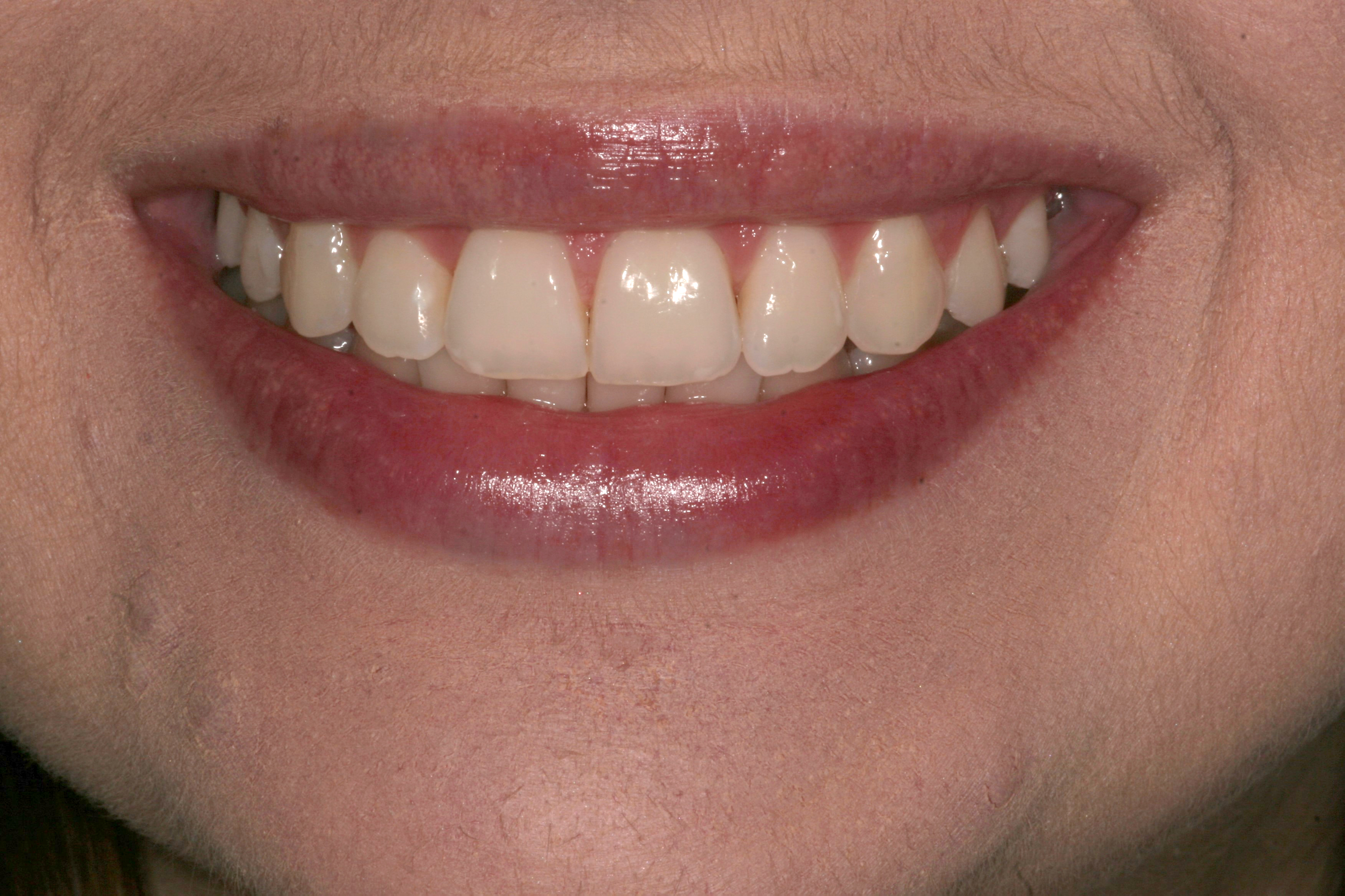 Gum and tooth reshaping dentist Madison