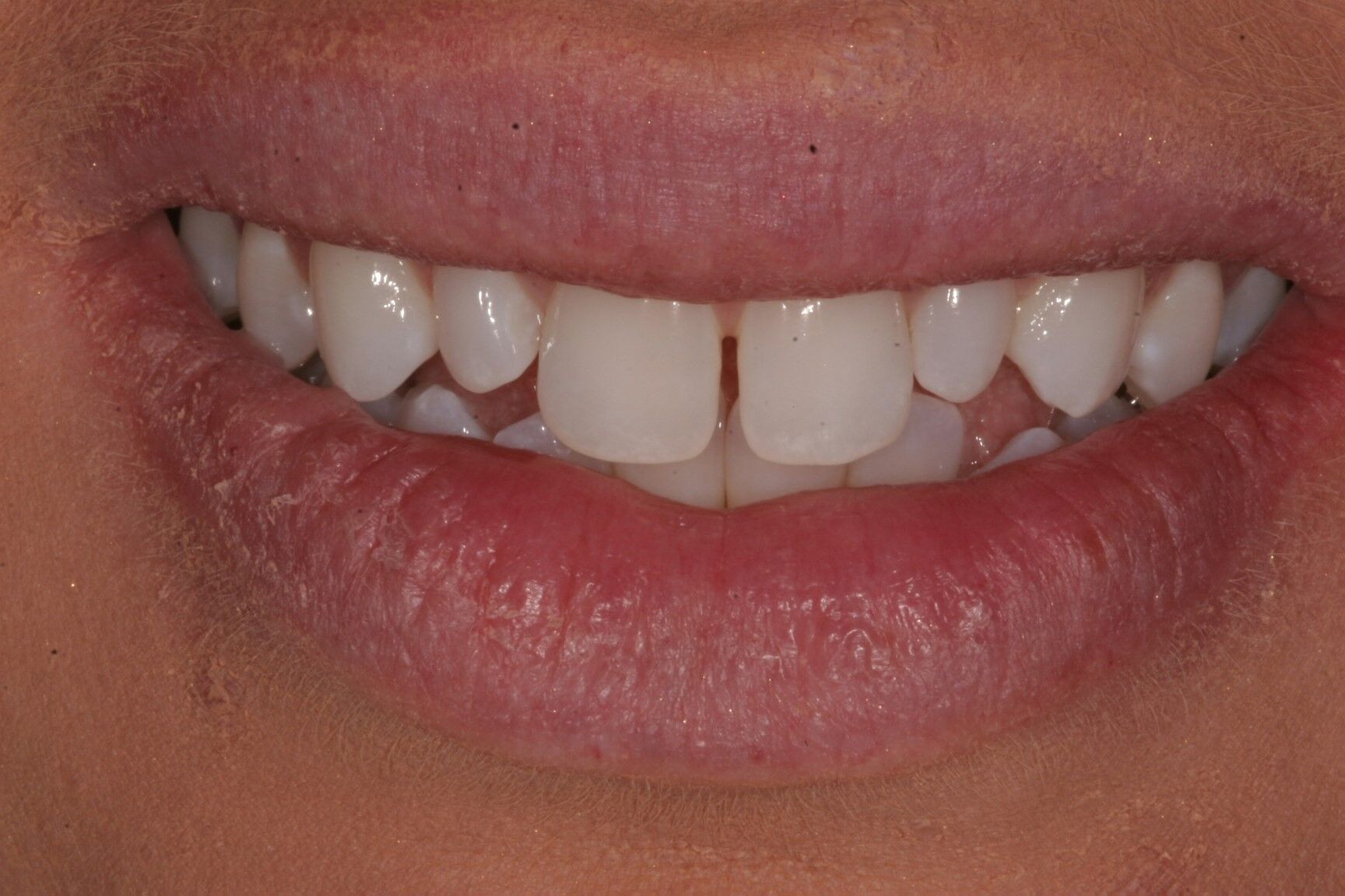 Invisalign success story Madison, WI