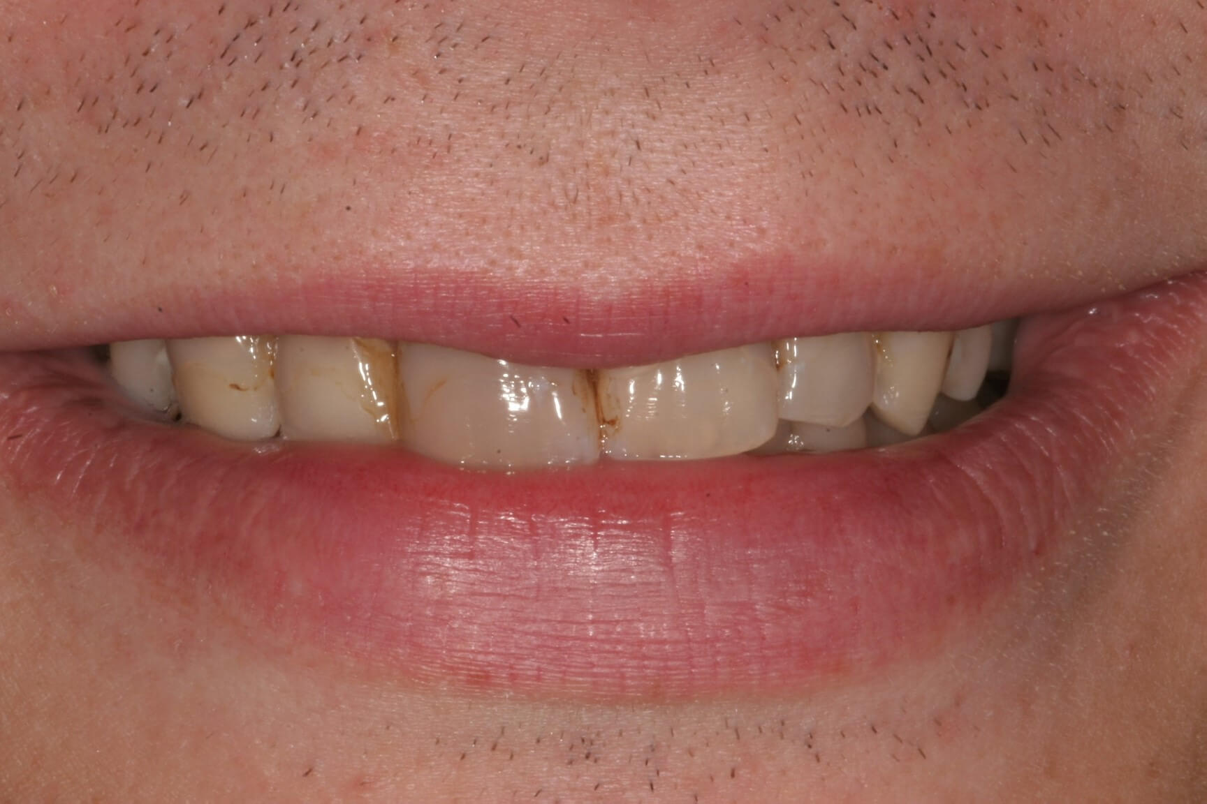 porcelain crown cavity replacement dentistry