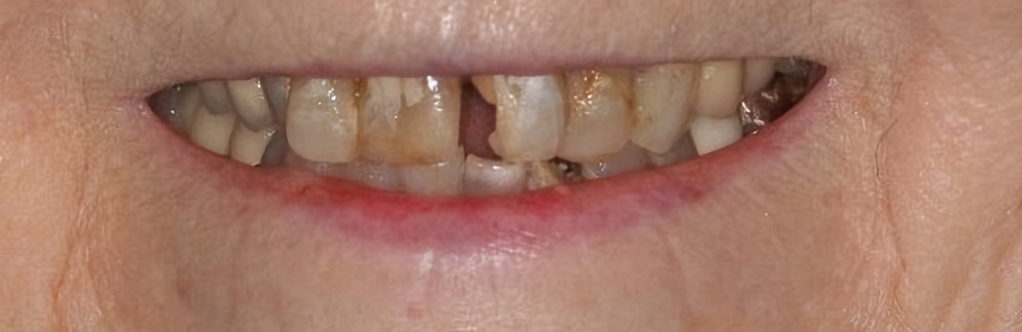 Porcelain restoration dental work